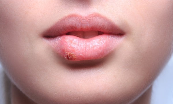 Herpes (Genital or Orofacial) Treatment